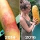 Read more about the article ECZEMA healing stories – EVELINA SUSANA
